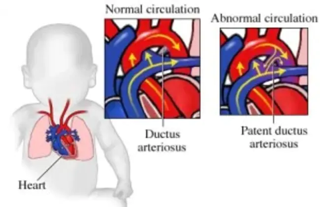 cardiogeneic pulmonary oedema : 心源性肺水肿