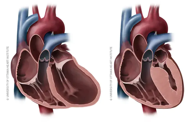 CardioMyopathy Syndrome : 心肌病综合征