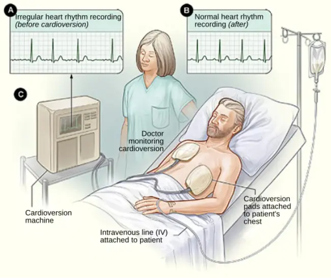 CardioPlegic Solution : 心脏停搏液
