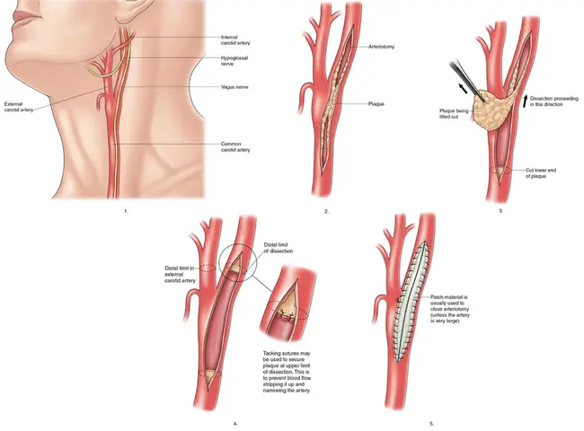 Carotid Foramen : 颈动脉孔