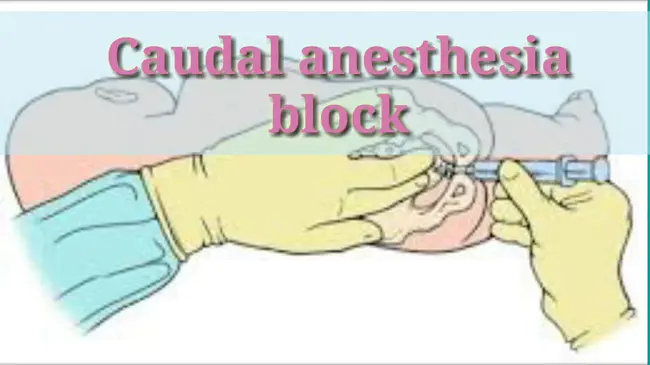 Caudal Epidural Analgesia : 尾硬膜外镇痛