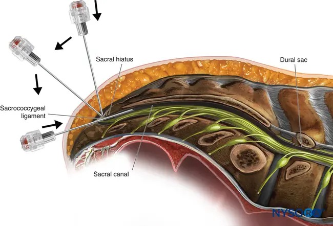 Caudal Mesenteric Plexus : 肠系膜尾丛