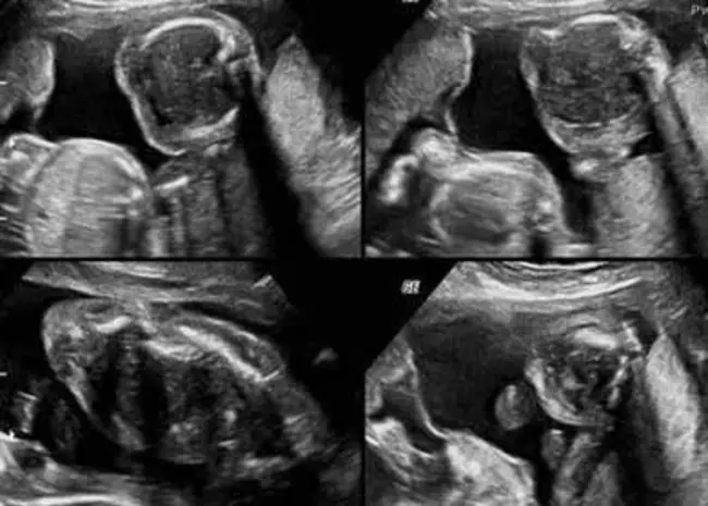 Caudal Regression Syndrome : 尾回归综合征