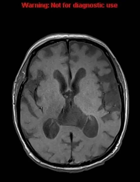 Cavum Septum Pellucidum : 透明腔隔