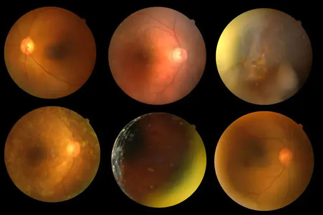 Central Serous Retinopathy : 中心性浆液性视网膜病变