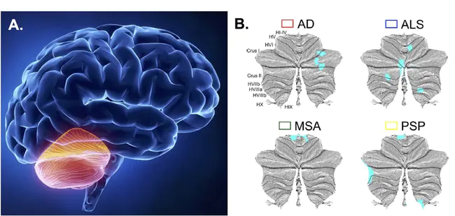 Cerebellar Degeneration : 小脑变性