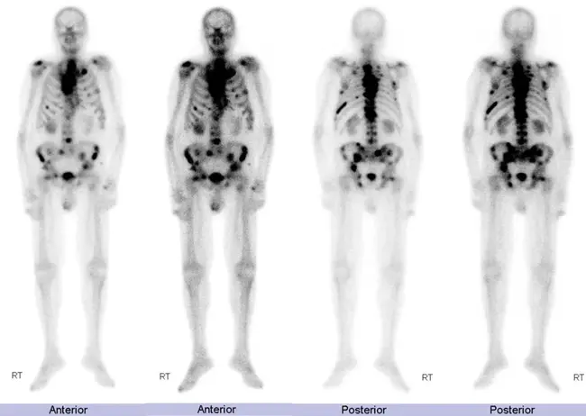 Cerebral Metastases : 脑转移