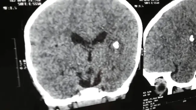 cerebrocortical necrosis : 脑皮质坏死