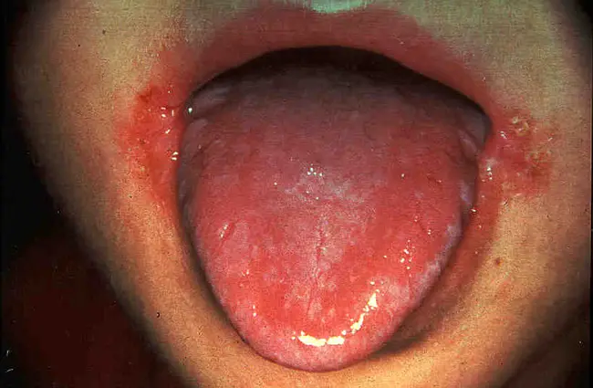 Cheilitis Glandularis : 腺性唇炎