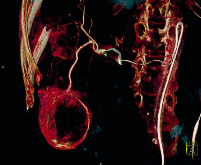 chemoembolisation : 化疗栓塞