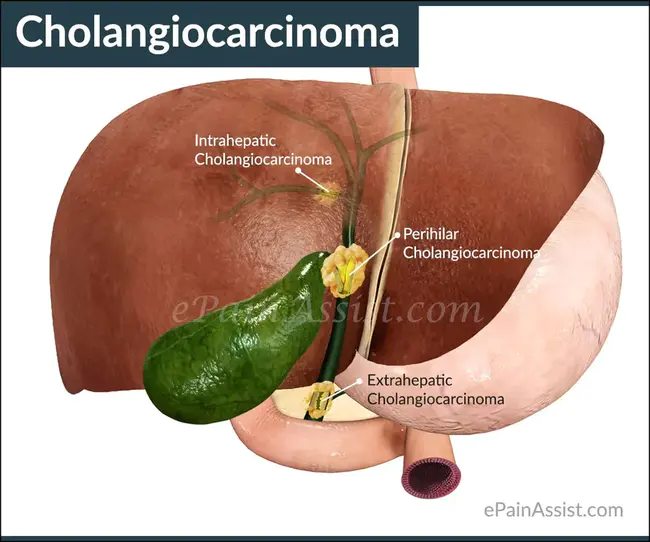 cholangiocarcinoma : 胆管癌