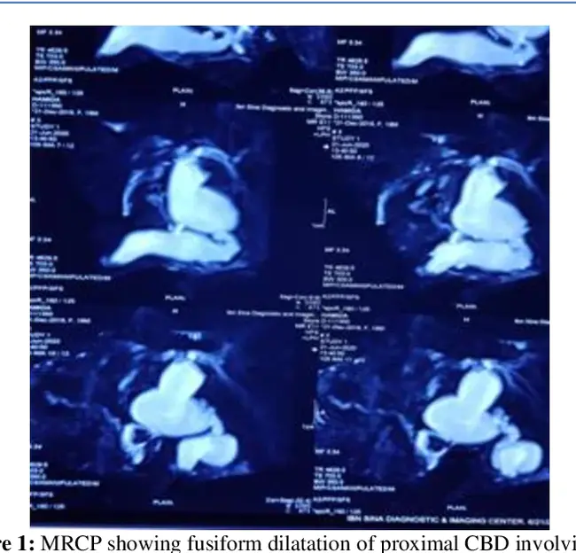 Choledochal Cyst : 胆总管囊肿