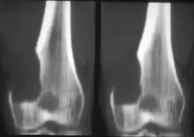 ChondroMyxoid Fibroma : 软骨粘液样纤维瘤