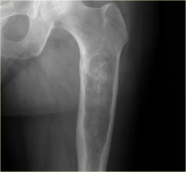 chondrosarcoma : 软骨肉瘤