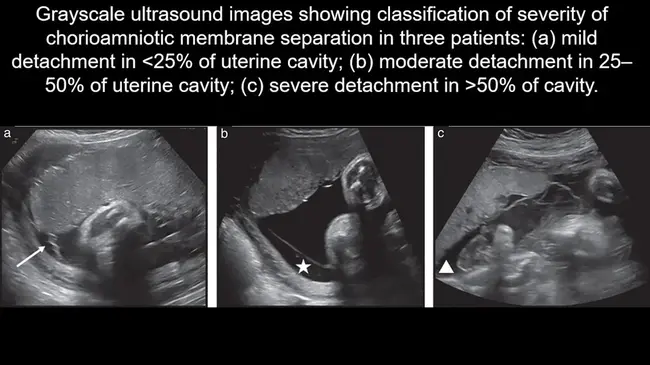 Chorioamniotic Membrane Separation : 绒毛膜羊膜分离