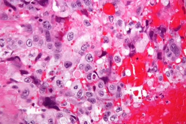 choriocarcinoma : 绒毛膜癌