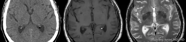 Choroid Plexus Carcinoma : 脉络丛癌