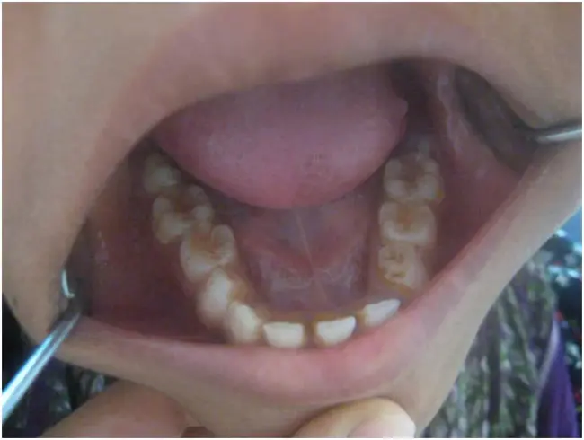 Chronic Adult Periodontal Disease : 慢性成人牙周病