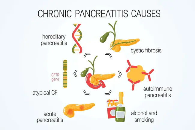 Chronic Alcoholic Pancreatitis : 慢性酒精性胰腺炎