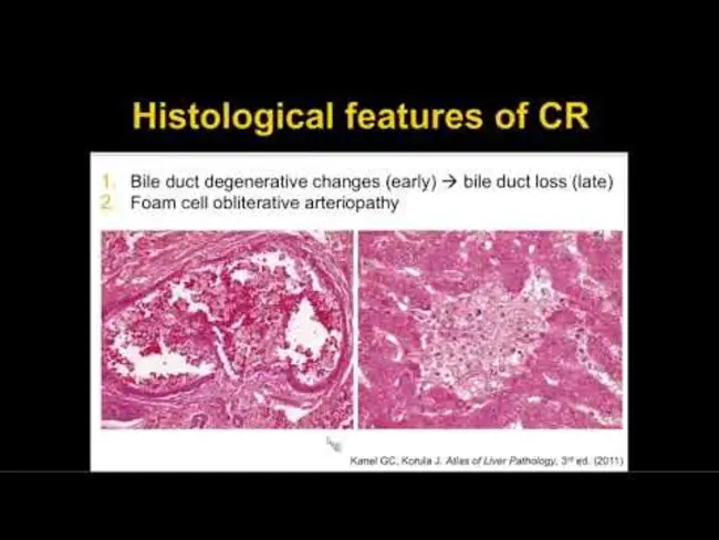 Chronic Allograft Failure : 慢性同种异体移植失败