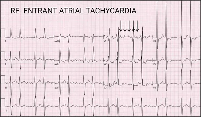 Chronic Atrial Fibrillation : 慢性房颤