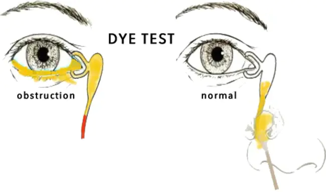 Chronic Duodenal Obstruction : 慢性十二指肠梗阻