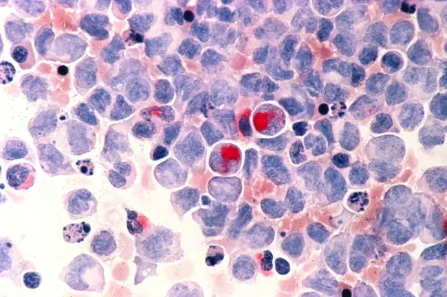 Chronic Myeloid Leukaemia : 慢性髓性白血病