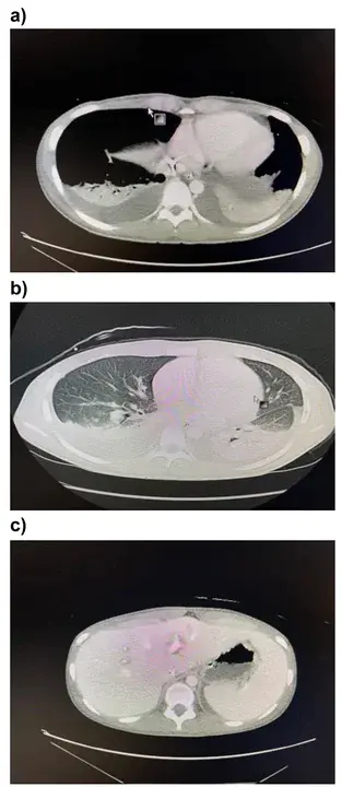 chronic pulmonary emphysema–COPD is widely preferred : 慢性肺气肿-慢性阻塞性肺病是广泛的首选。