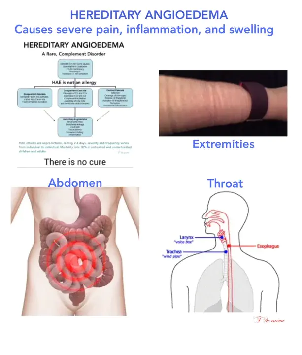 Chronic Urticaria and Angiooedema : 慢性荨麻疹和血管水肿