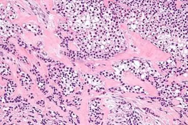 Clear Cell Adenocarcinoma : 透明细胞腺癌
