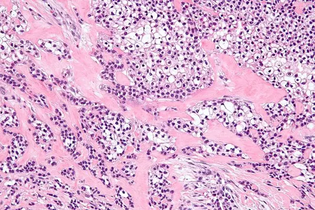 Clear Cell Endothelioma : 透明细胞内皮瘤