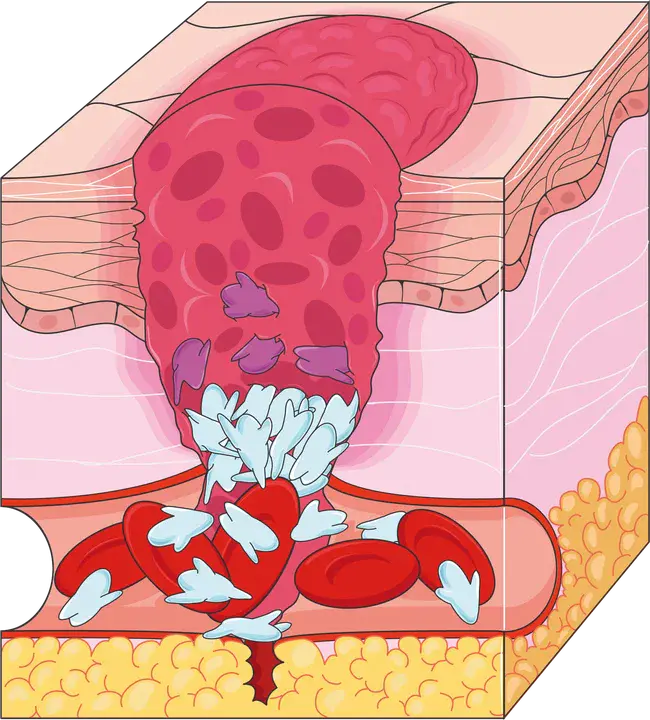 Coagulation Index : 凝结指数