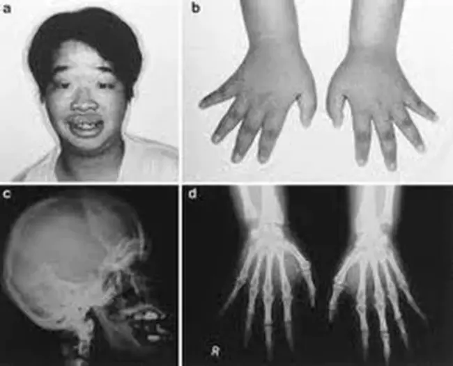 Coffin-Lowry syndrome : Coffin-Lowry综合征