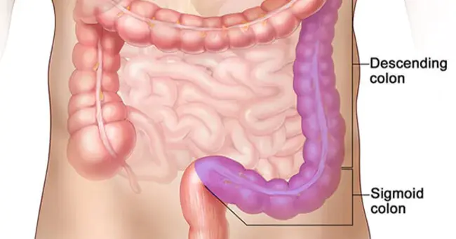 colorectal distension : 结直肠扩张