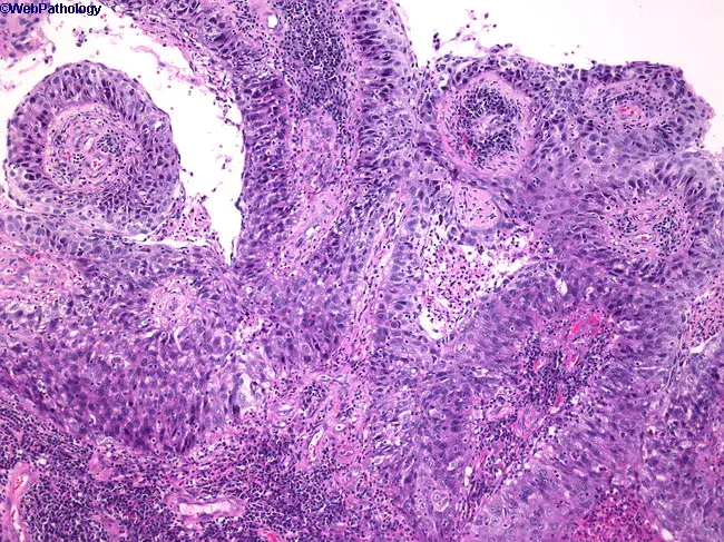 Columnar Cell Papilloma : 柱状细胞乳头状瘤