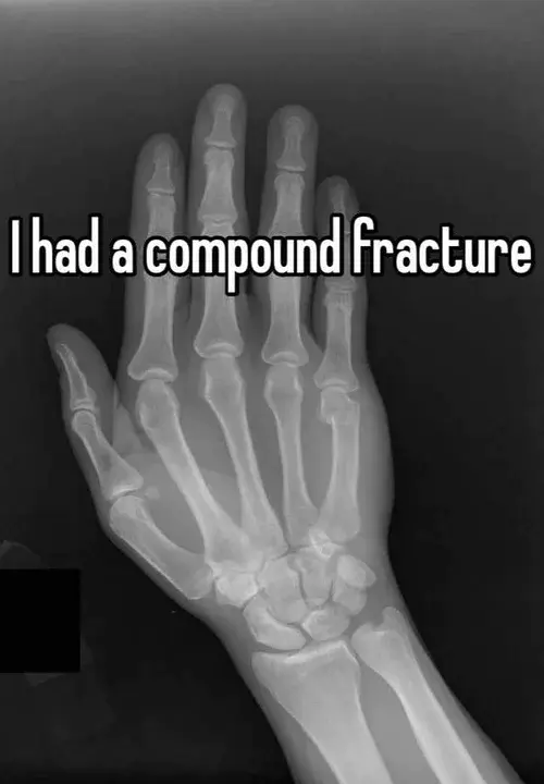 Compound Comminuted Fracture : 复合粉碎性骨折