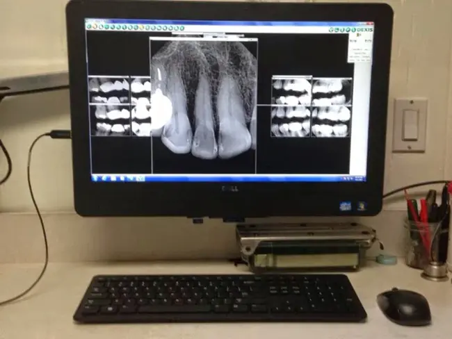 Computer-Assisted Myelography : 计算机辅助脊髓造影术