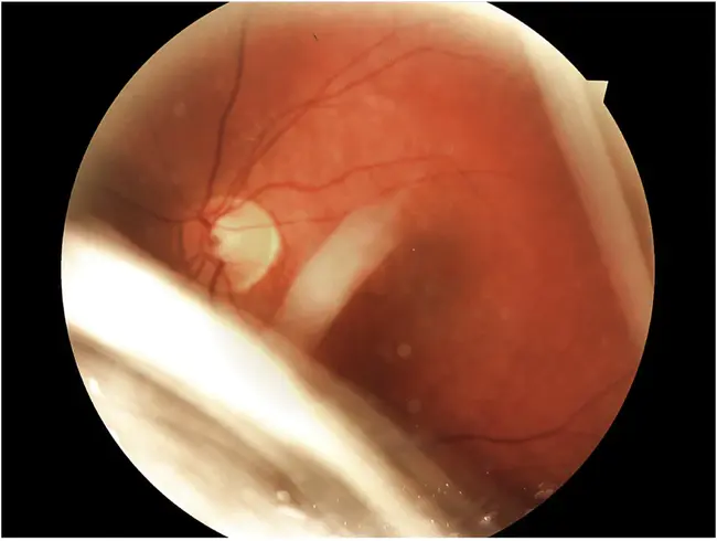 Cone Dystrophy : 锥体营养不良