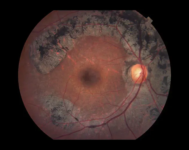 Cone-Rod Dystrophy : 锥杆营养不良