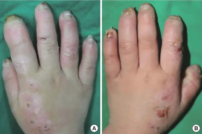 Congeital Nevus : 粘液痣