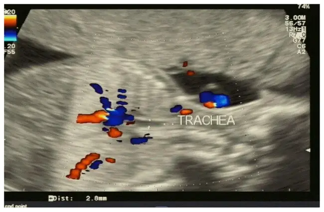 Congenital High Airway Obstruction Syndrome : 先天性高气道阻塞综合征