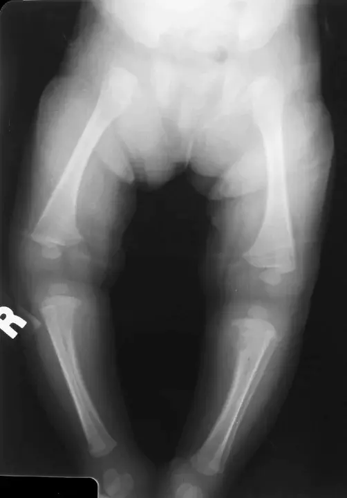 Congenital Syphilis : 先天性梅毒