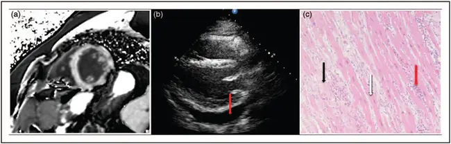 Congestive Cardiomyopathy : 充血性心肌病