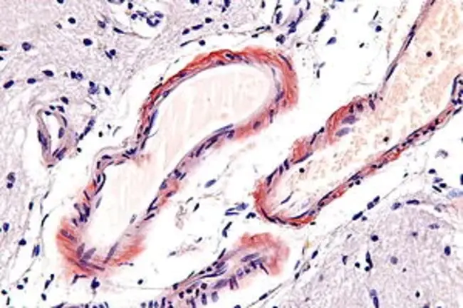 Congophilic Amyloid Angiopathy : 丛生淀粉样血管病