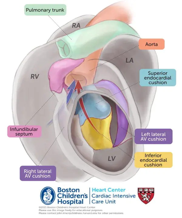 conotruncal defects : 锥体缺陷