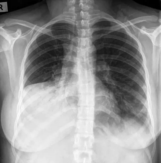 consolidation chemotherapy : 巩固化疗