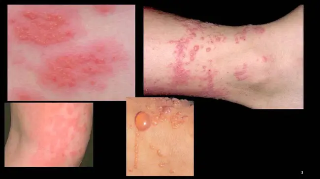 Contact Dermatitis : 接触性皮炎