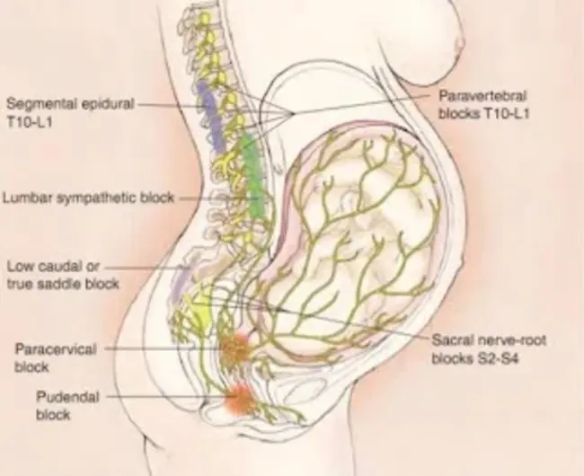 Continuous Epidural Analgesia : 持续硬膜外镇痛