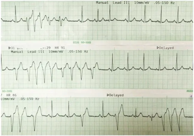 Continuous Hepatic Artery Infusion : 持续肝动脉灌注