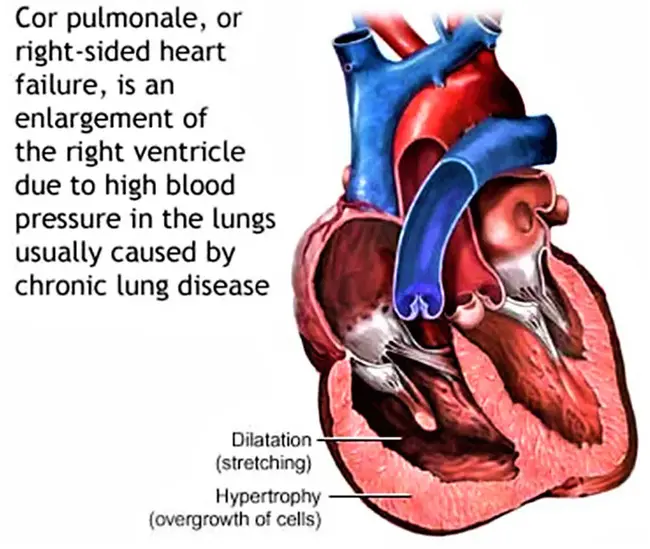 Cor Pulmonale : 肺心病